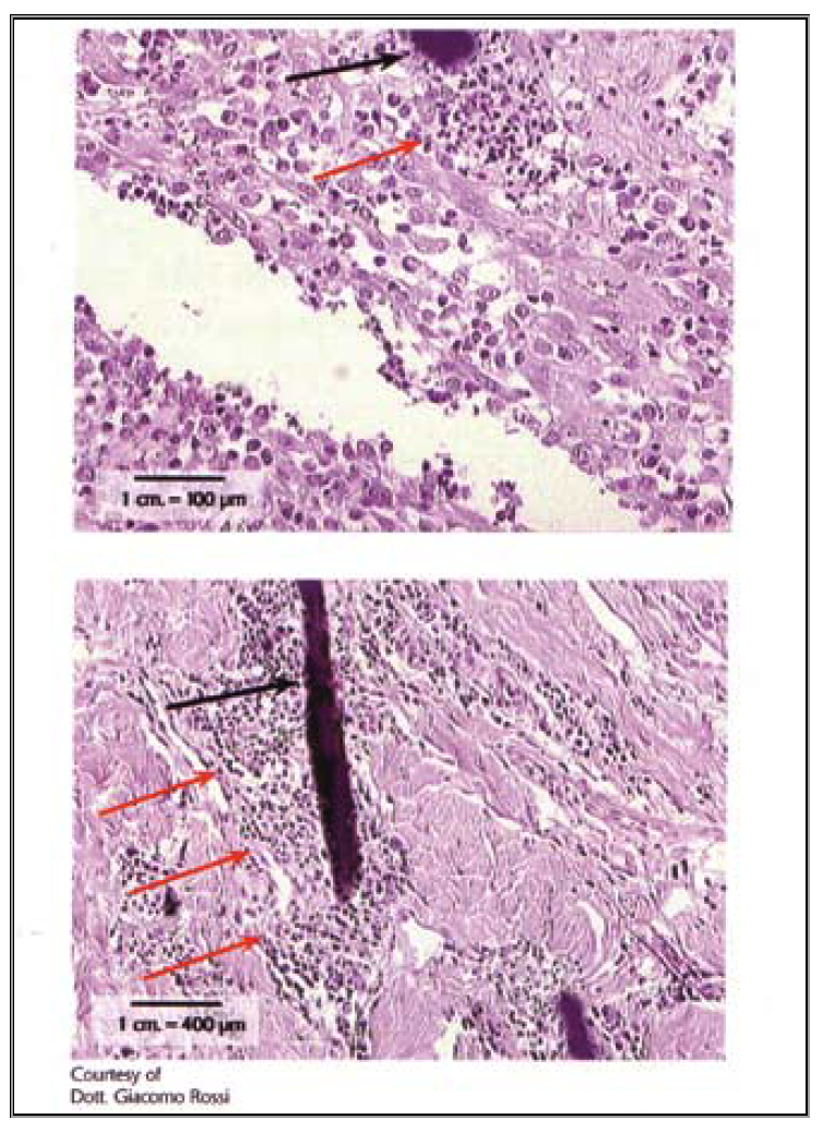 Surgical Laser Comparison With Traditional Scalpel And Electrosurgical